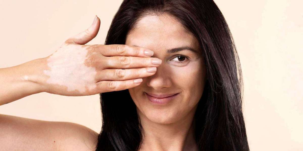 Best Vitiligo Cream & Natural Vitiligo Home Remedy | Kayakalp Global