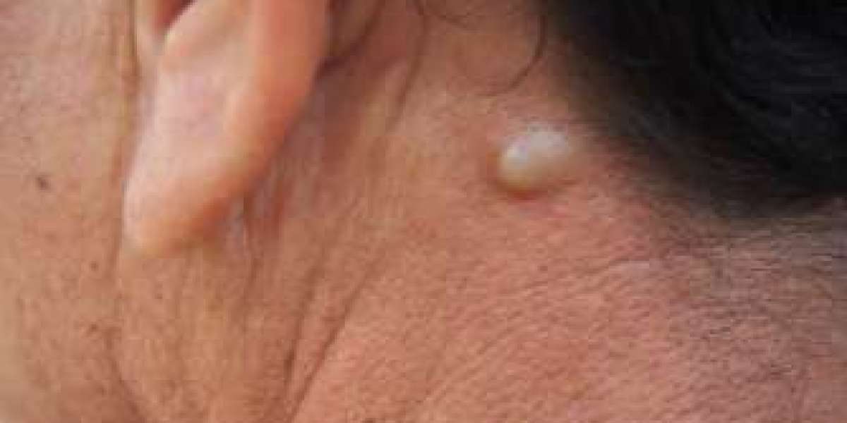 Natural Remedies and Medical Treatments for Sebaceous Cysts