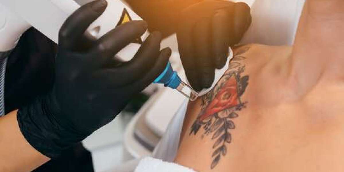 Reveal Clear Skin with Expert Laser Tattoo Removal