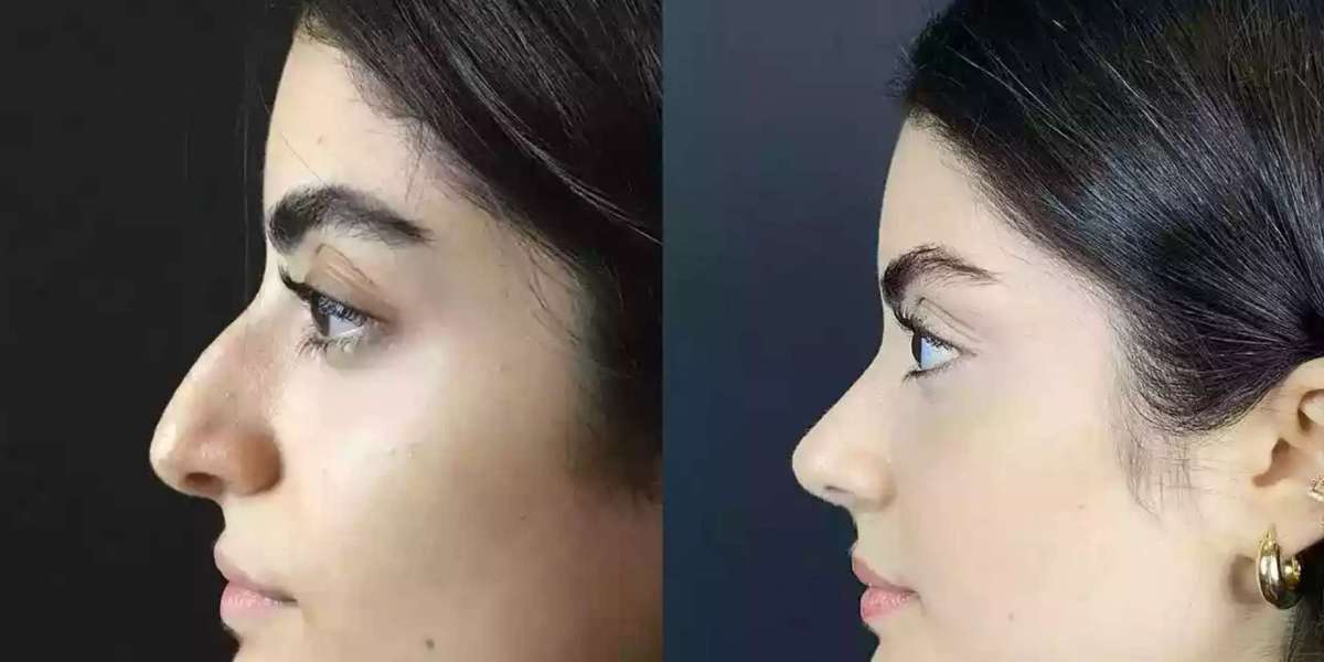 Surgical Precision by the Best Rhinoplasty Surgeons in Dubai