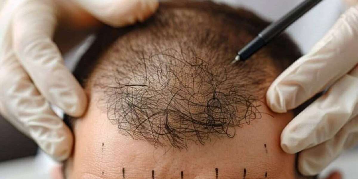Top 10 Questions to Ask Before a Hair Transplant in Islamabad