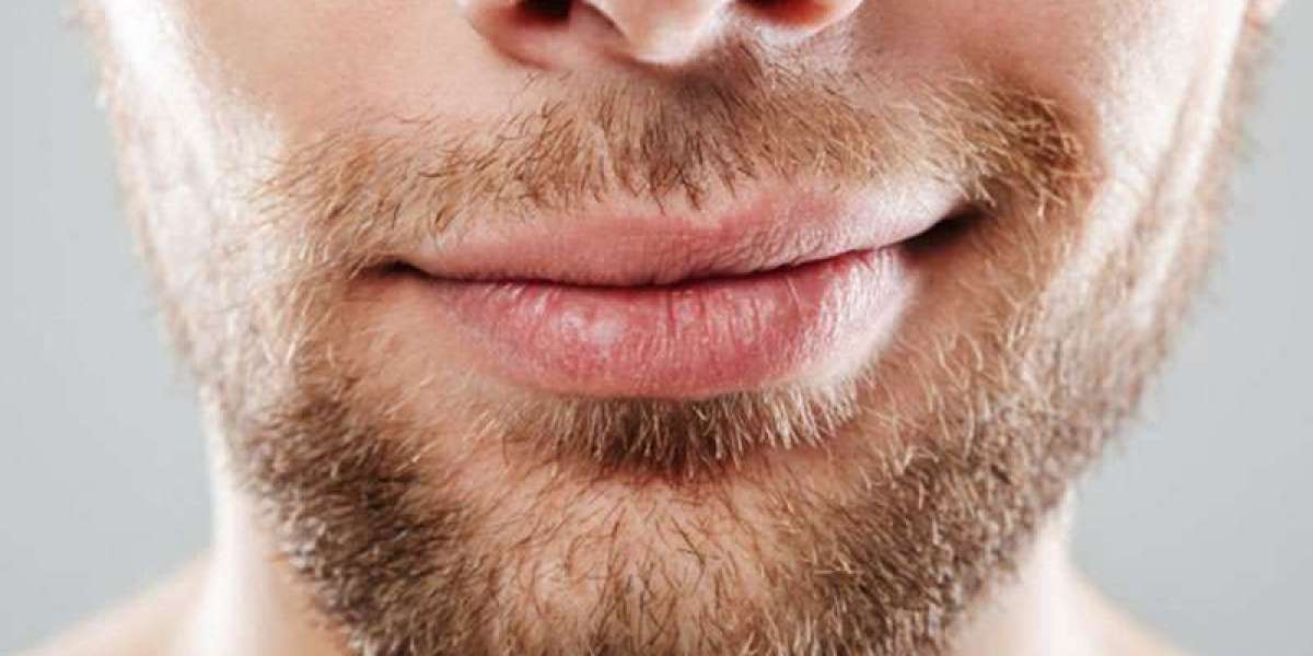 Mustache Hair Transplant: Stepwise Procedure