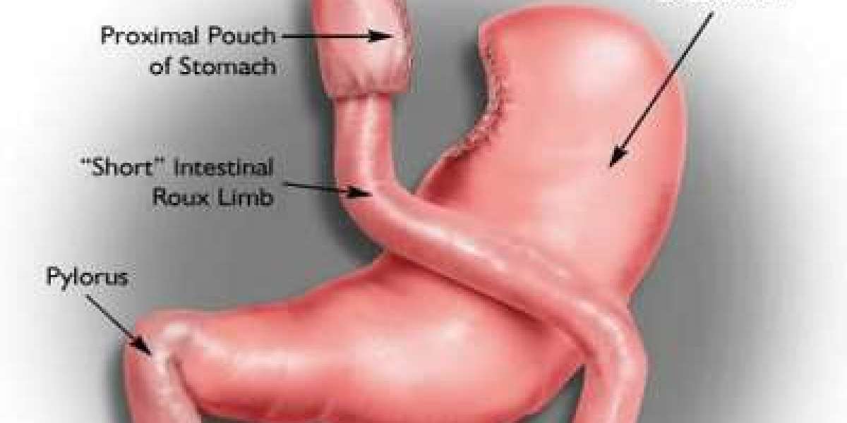 Metabolic Reset Through Surgery: Understanding the Impact of Gastric Bypass on Metabolic Syndrome