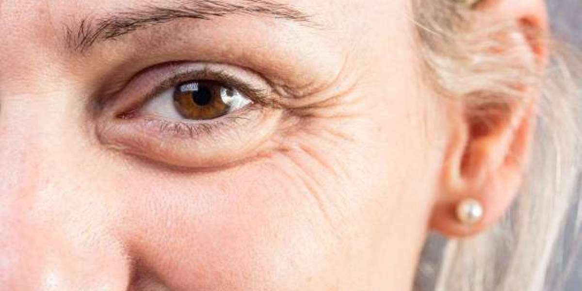 Eyelid Surgery in Islamabad: Rejuvenate Your Eyes with Expert Care