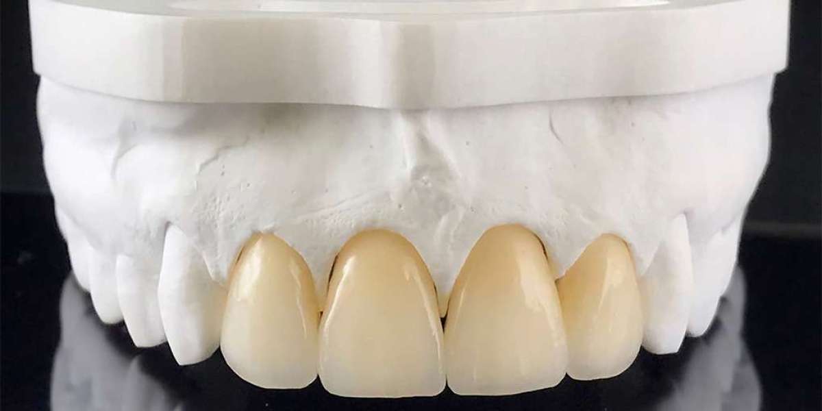 Zirconia Crown Dubai – Strong & Natural-Looking Crowns