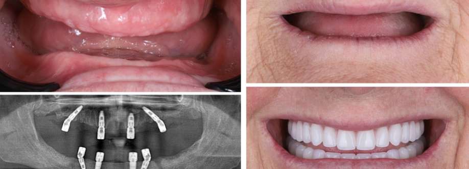 My Implant Dentist South Perth