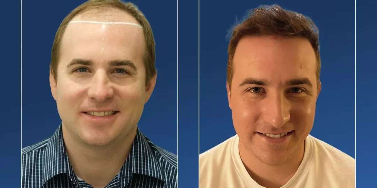 Hair Transplant Istanbul: Preparing for Your Consultation