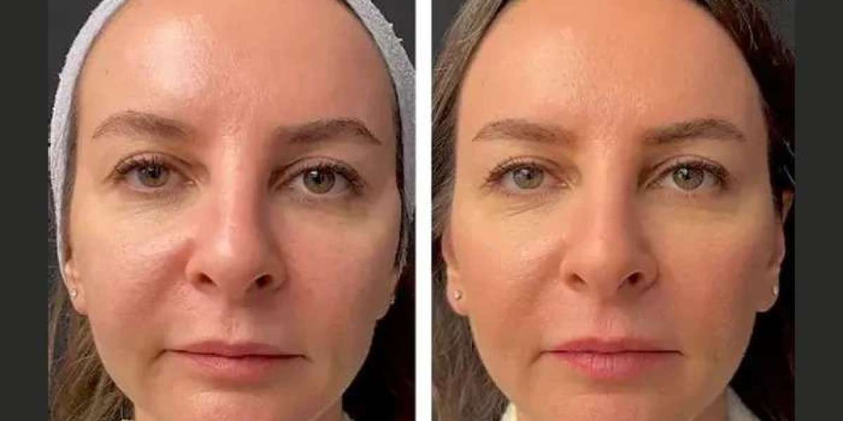 Mesotherapy in Dubai for Stretch Marks Reduction