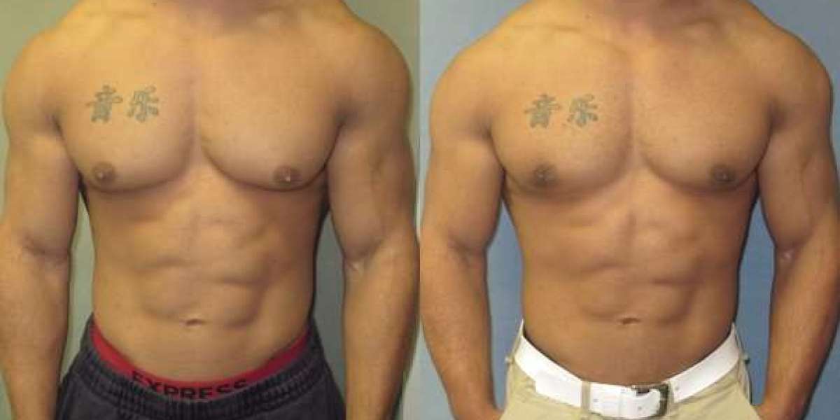 Discover Gynecomastia Surgery Cost Details for Perfect Results