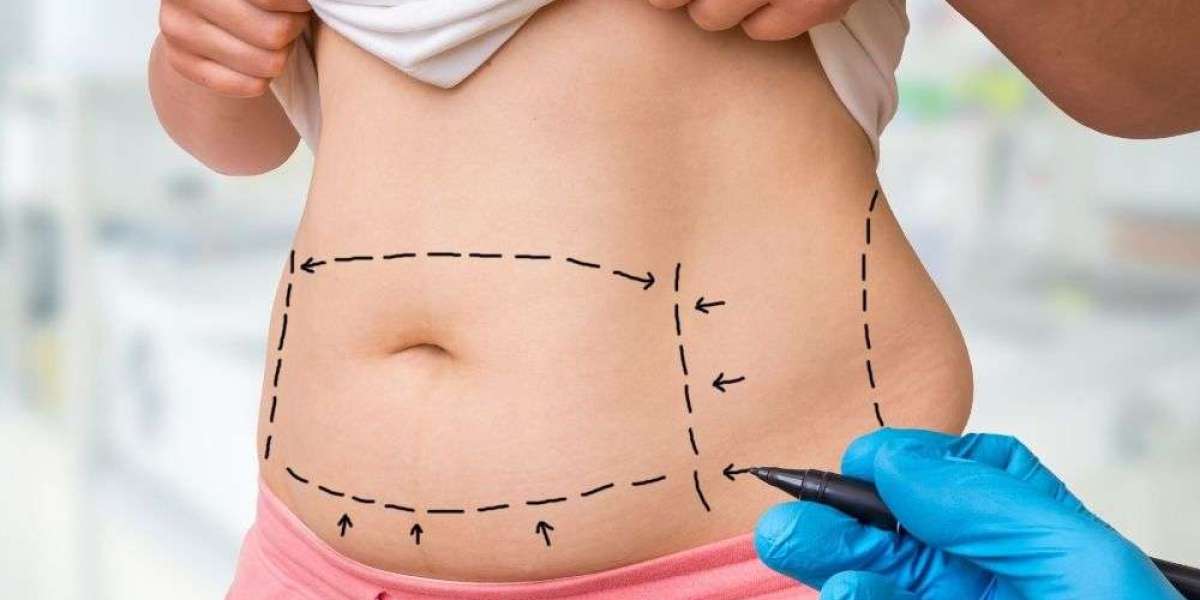 Remove Excess Fat and Skin with Lipo Abdominoplasty
