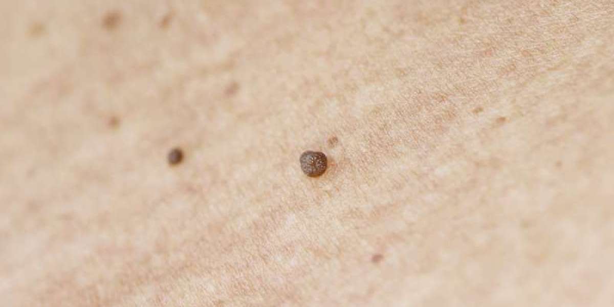 Skin Tag Removal in Dubai: Cost, Safety & Recovery Tips