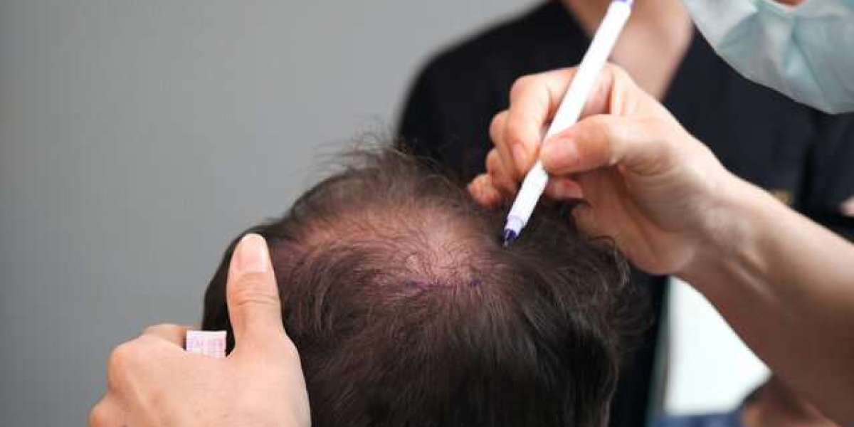 Hair Loss Treatments: Evidence-Based Updates