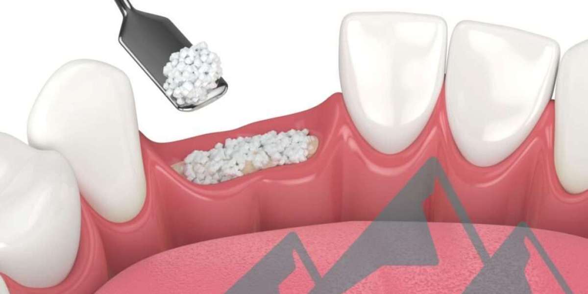 Bone Grafting vs Ridge Preservation: Key Differences