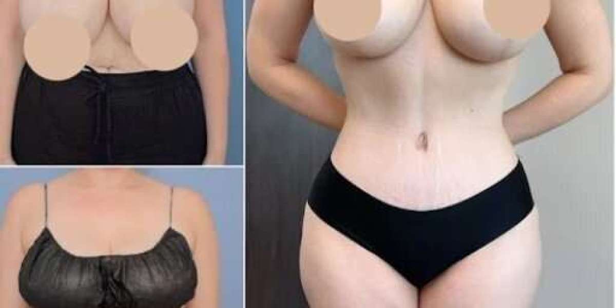 Best Tummy Tuck Surgeon in Dubai for Personalized Abdominoplasty