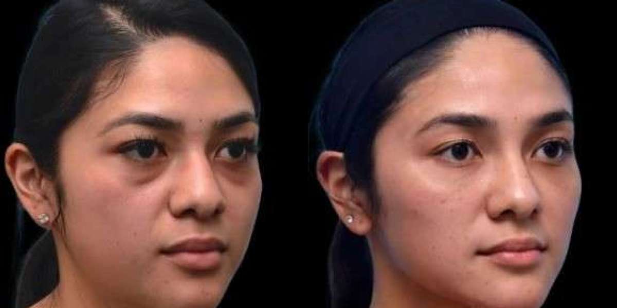 Best Doctors in Dubai for Dark Circles Treatment in Different Skin Types