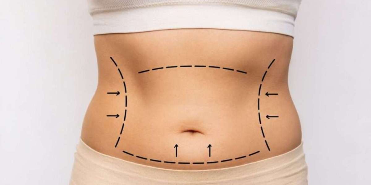 The Art of Abdominal Sculpting