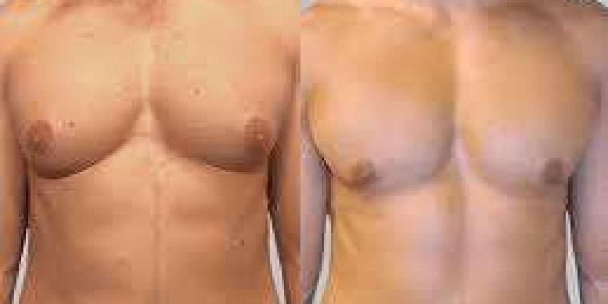 Causes of Gynecomastia in Men: Insights from Islamabad Experts