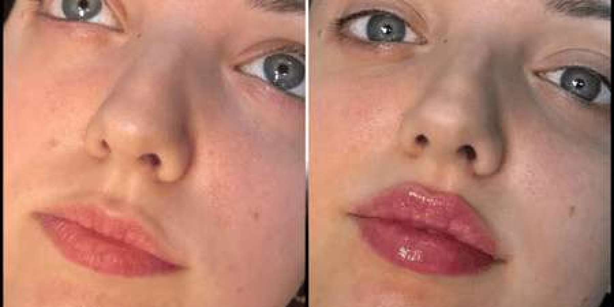 Fillers in Dubai for Non-Surgical Facial Enhancement