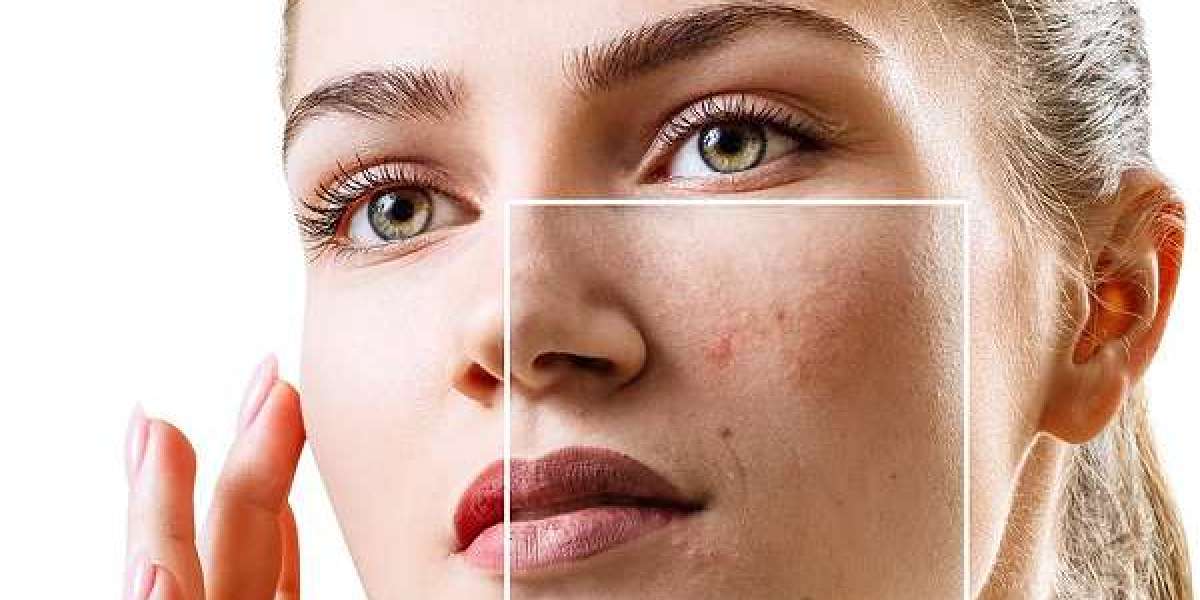 Dubai Acne Scar Solutions: Guide for Patients