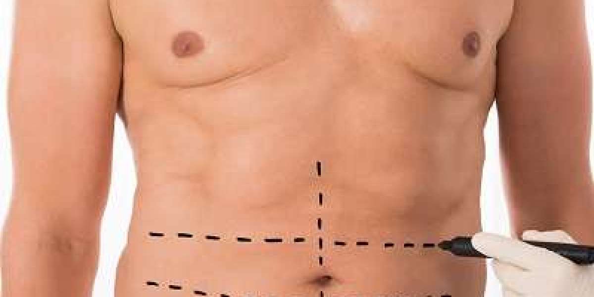 Everything You Should Know About Liposuction Procedures in Islamabad