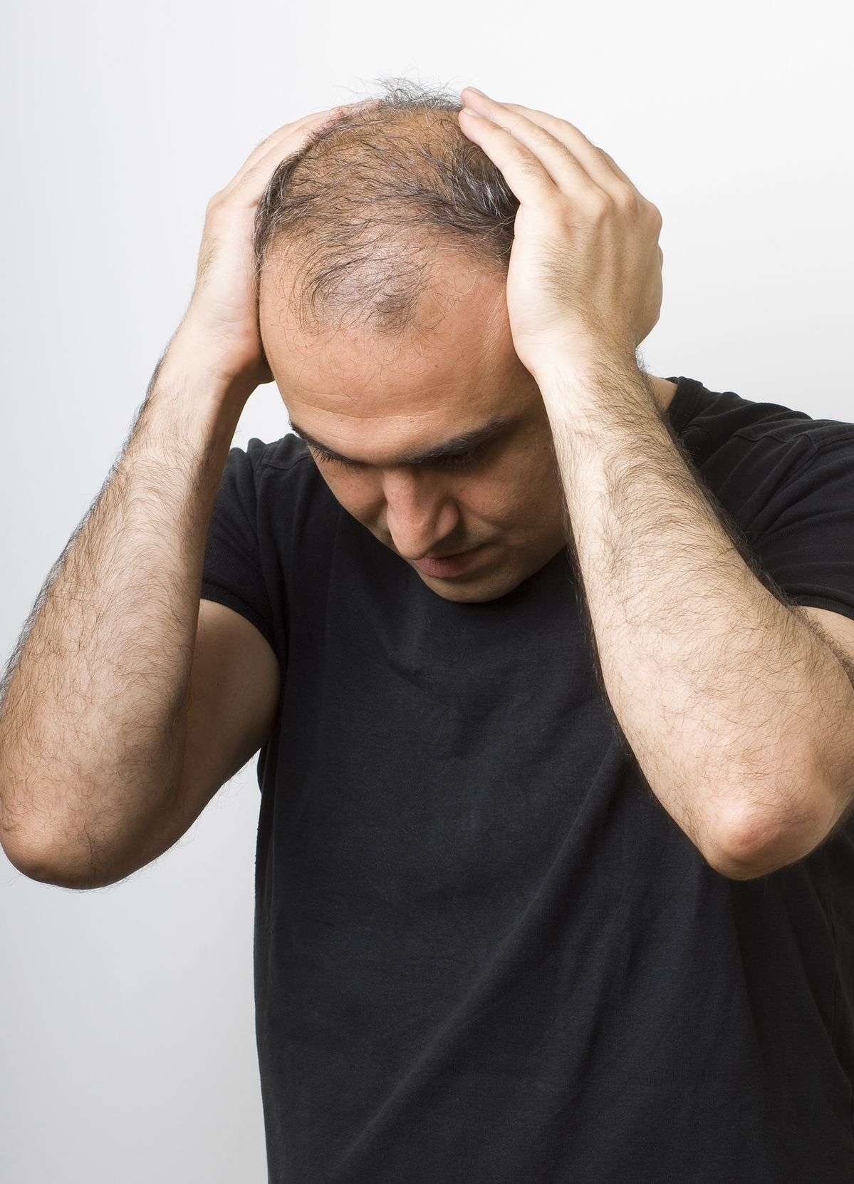 Hair Transplantation