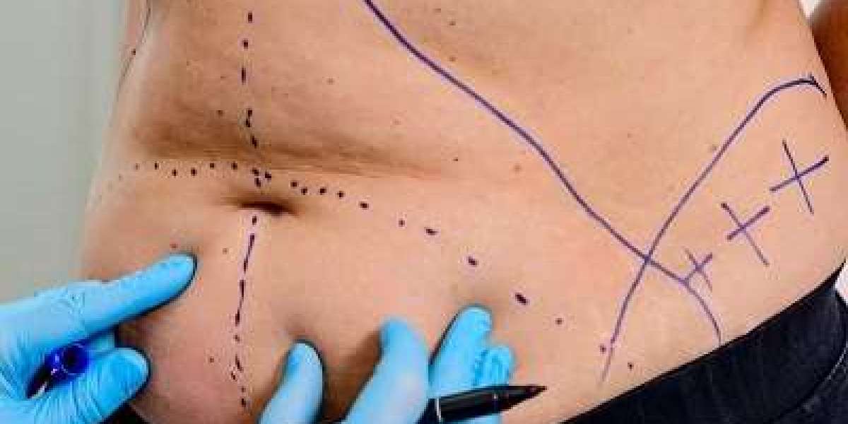 Liposuction in Riyadh A Safe Path to Body Refinement