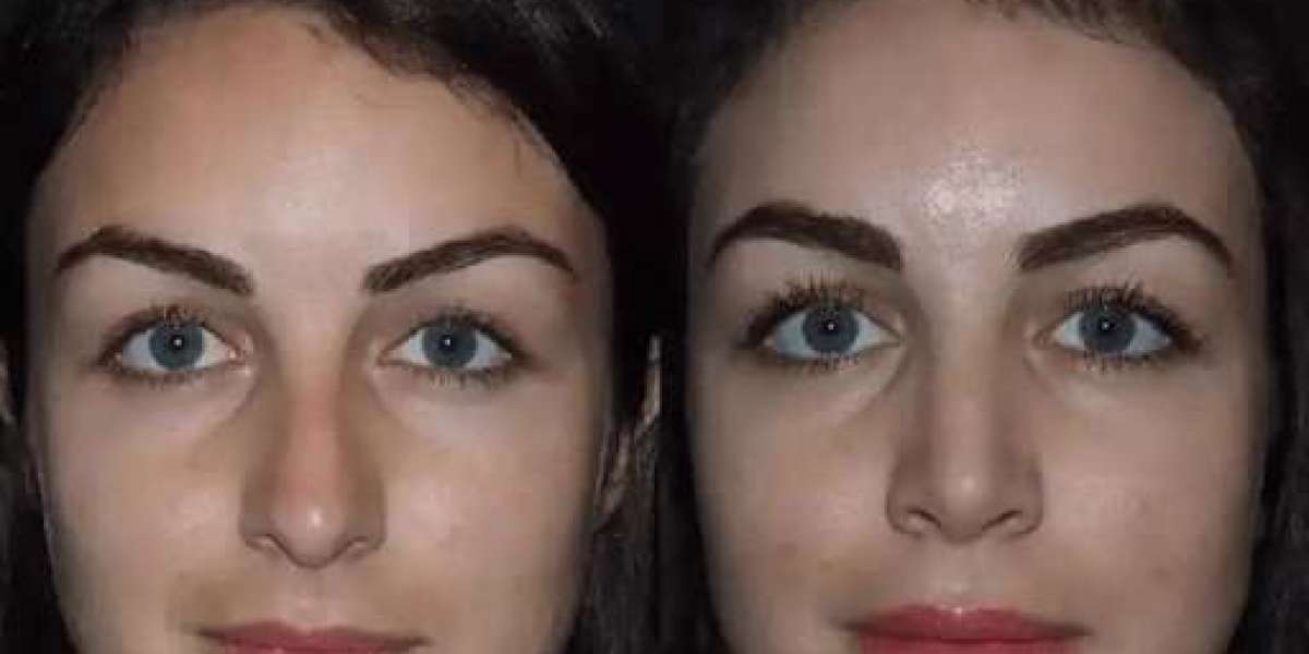 Best Doctors in Dubai for Rhinoplasty Trusted for Consistent Outcomes