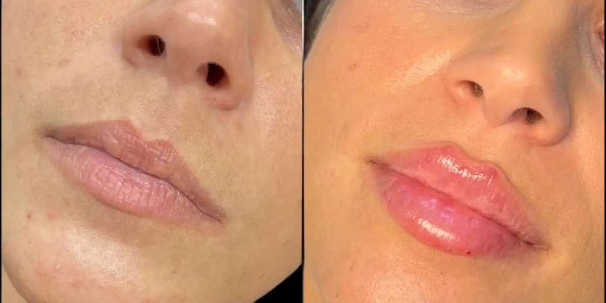 Transform Your Look at the Best Aesthetic Clinic in Dubai for Fillers