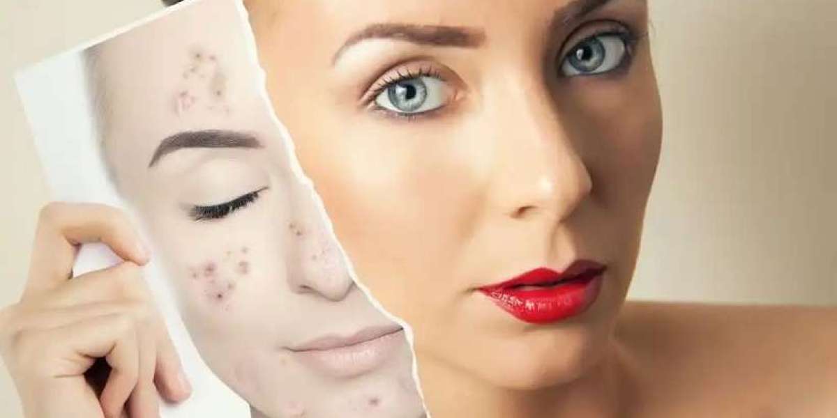 Dubai’s Most Recommended Acne Clinics