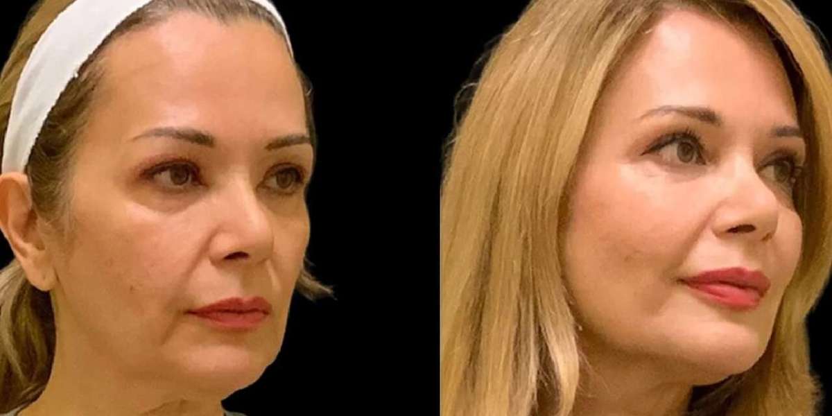 Cheek Fillers by Best Plastic Surgeons in Dubai What Makes Results Natural