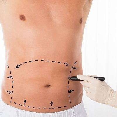 Tummy tuck in Islamabad- ERCs