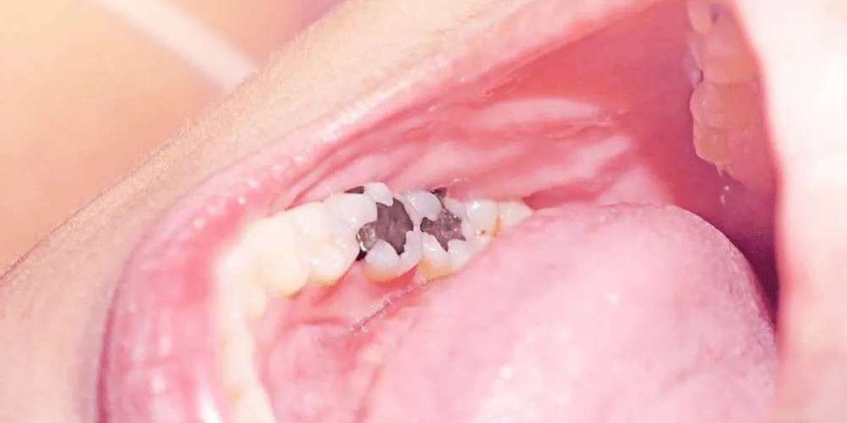 Dental Filling in Islamabad: Signs You Need Immediate Treatment