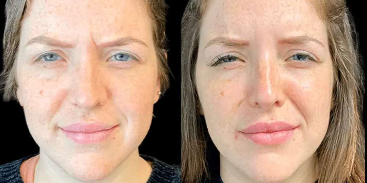 Best Aesthetic Clinic in Dubai: Non-Surgical Botox Options