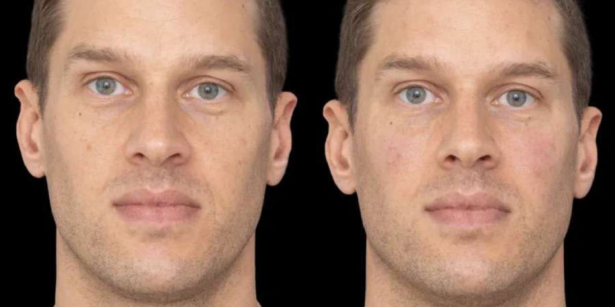 Best Plastic Surgeons in Dubai Discuss Modern Trends in Under Eye Fillers