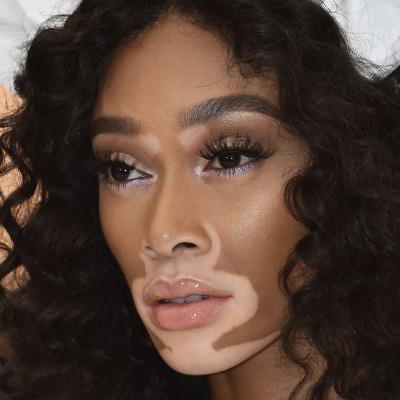 Vitiligo Treatment in Islamabad - Enfield Royal Clinic