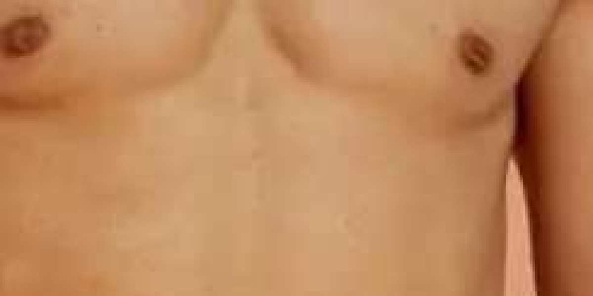 كل ما يجب معرفته قبل إجراء شفط الدهون في جدة