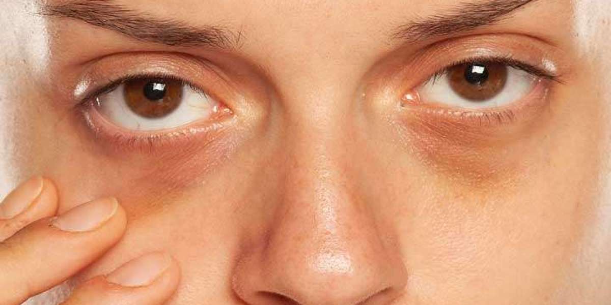 Dark Circles Treatment in Riyadh Precision Eye Area Care