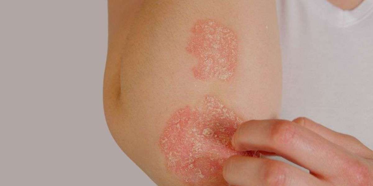How Long Does Eczema & Psoriasis Treatment Take in Dubai?