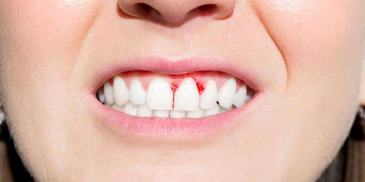 Best Gum Treatment Dubai Options, Costs & What to Expect