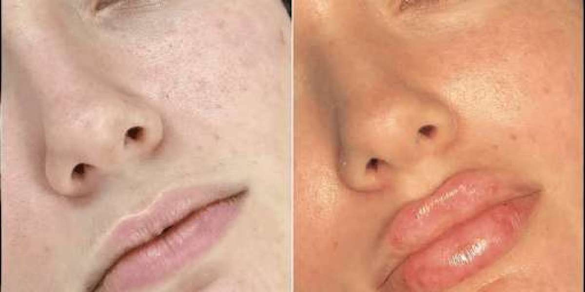 Fillers in Dubai for Enhancing Facial Symmetry