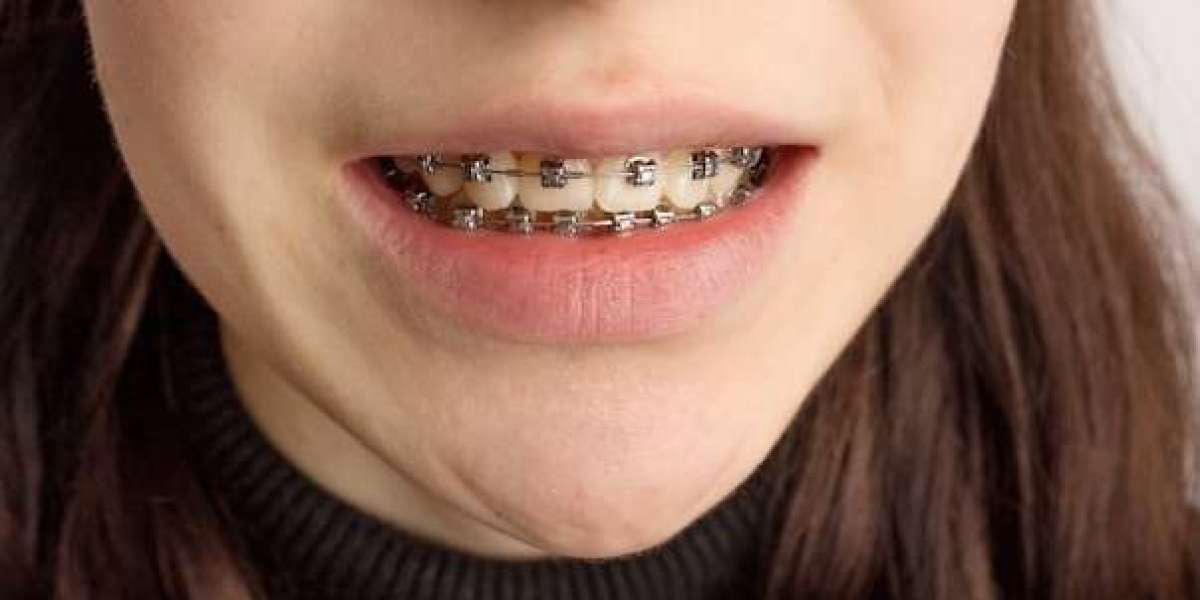 From Crooked to Confident: The Journey with Braces and Types of Braces for Perfecting Your Smile