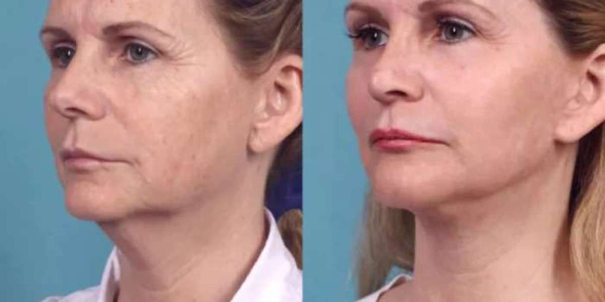 Chemical Peel Treatments in dubai for Anti-Aging Solutions