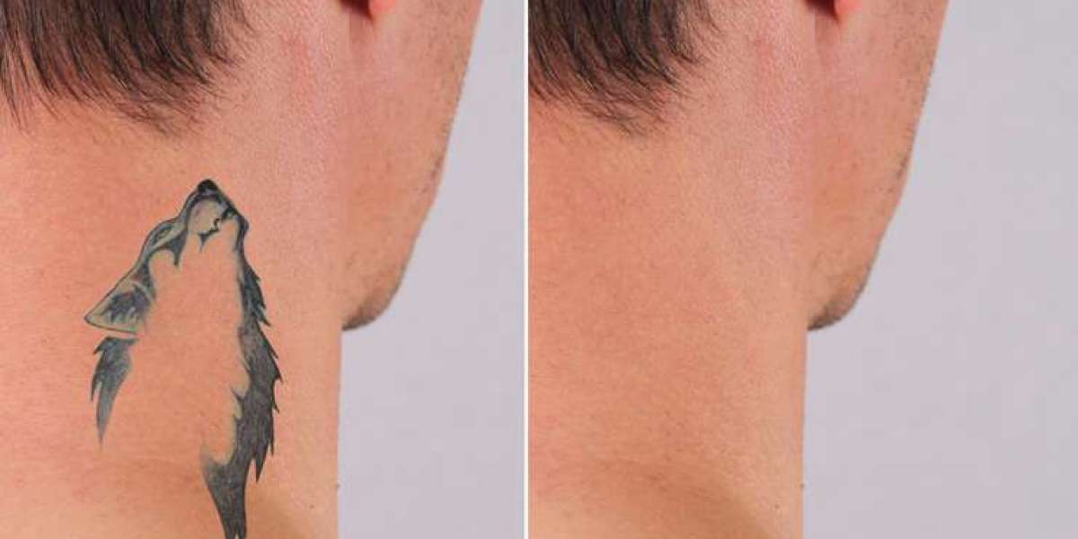 Affordable Laser Tattoo Removal Clinics in Islamabad