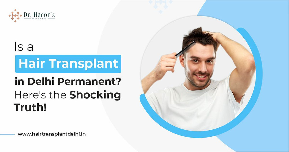 Is a Hair Transplant in Delhi Permanent? Here's the Shocking Truth!