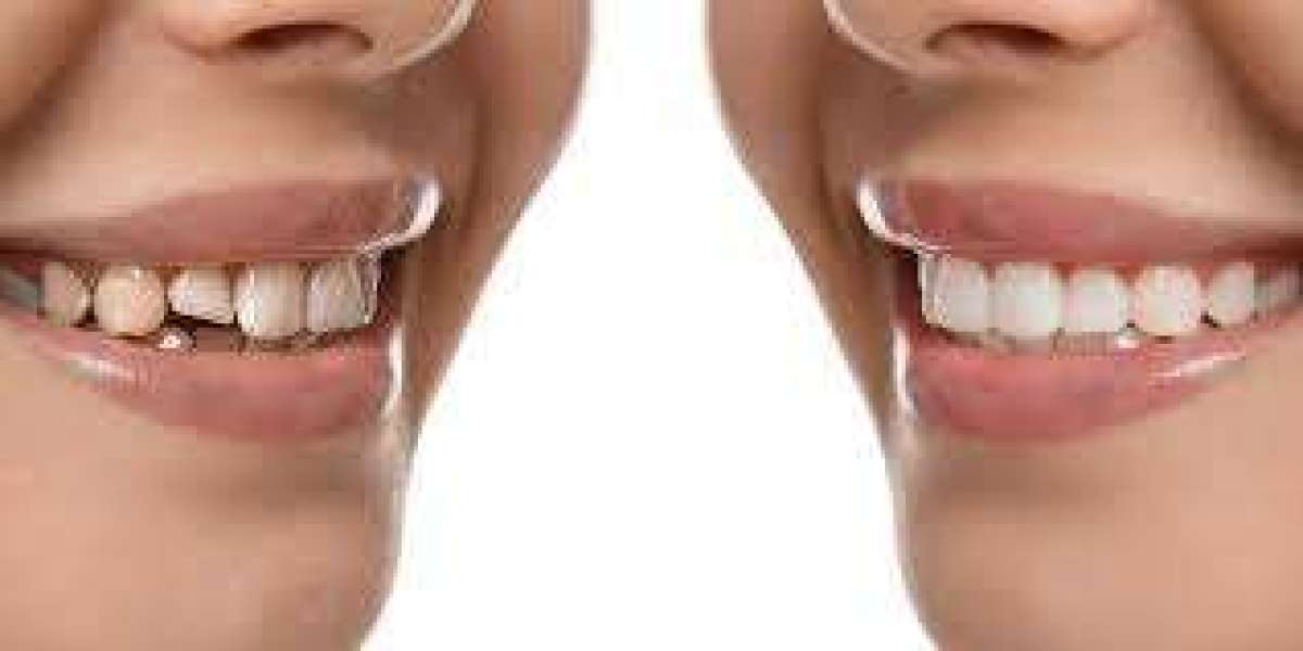 Achieve a Flawless Smile with Dental Bonding