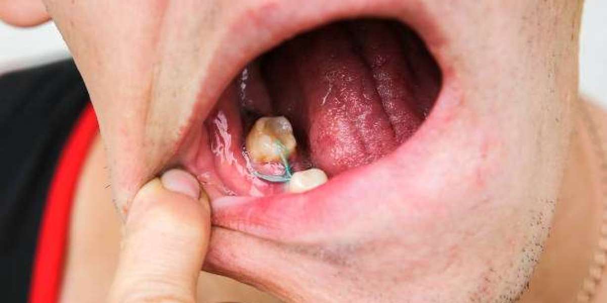 Gum Grafting in Islamabad: The Complete Mega Guide to Healthy Gums and a Beautiful Smile