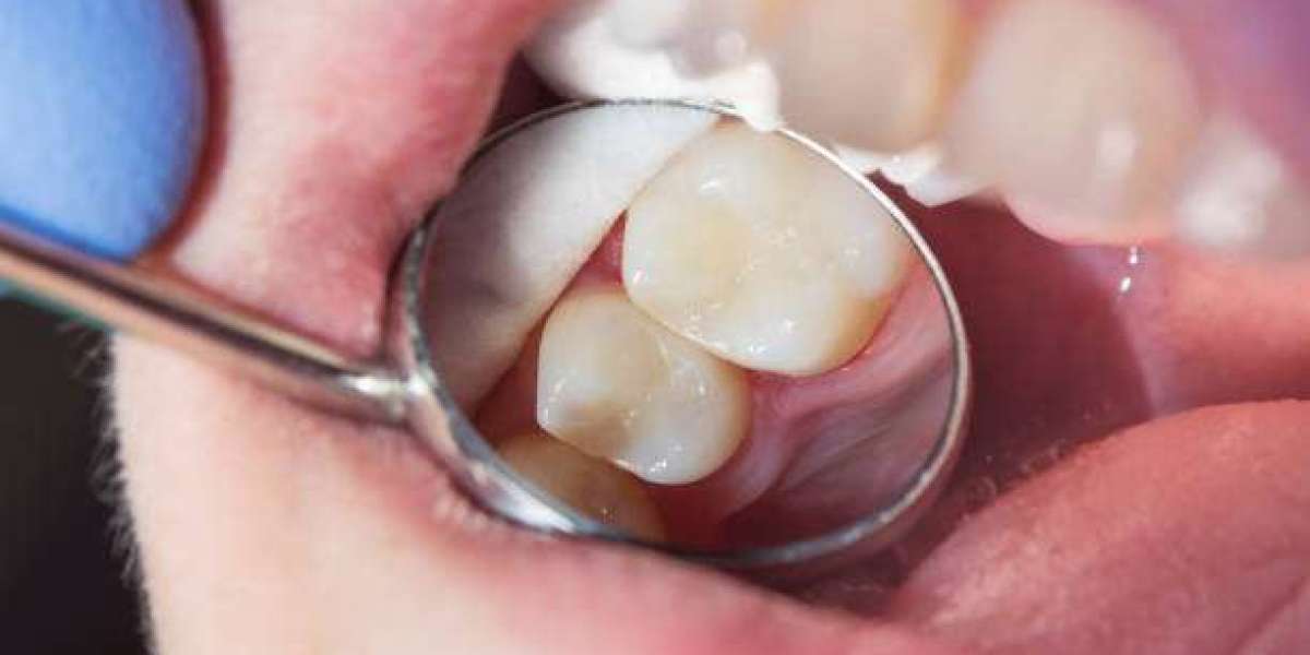 A Reliable Way to Save Your Natural Teeth Dental Fillings in Islamabad: