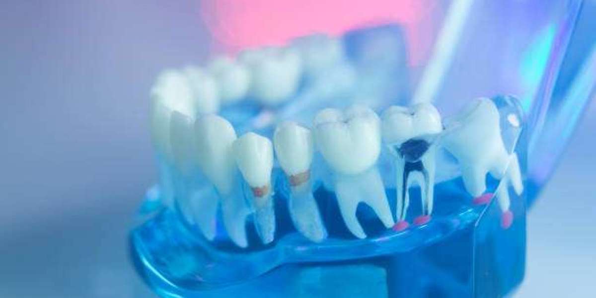 Root Canal Treatment in Islamabad: Restore Your Smile
