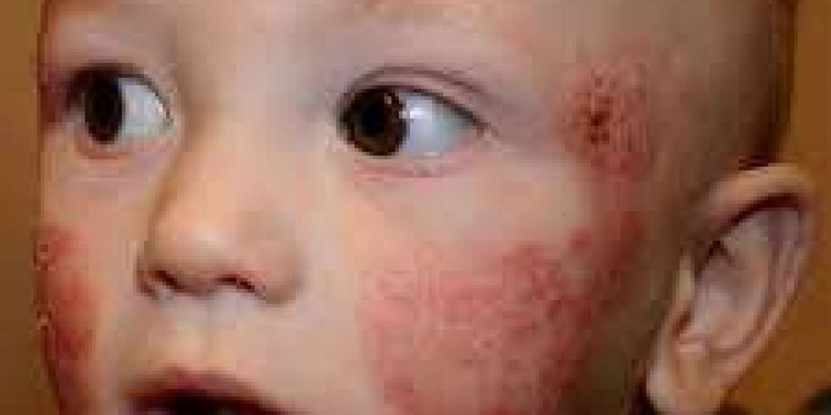 Atopic dermatitis market innovations transforming treatment paradigms and improving patient quality of life