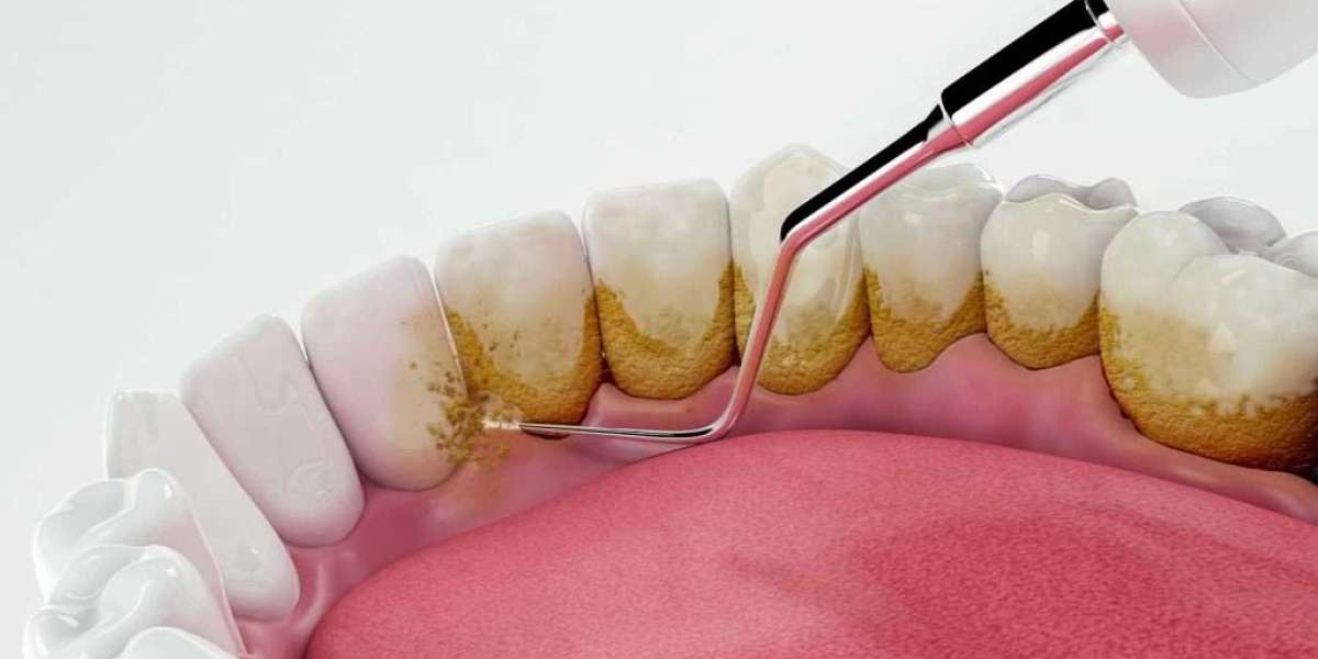 Teeth Cleaning for Maintaining Healthy Teeth and Gums
